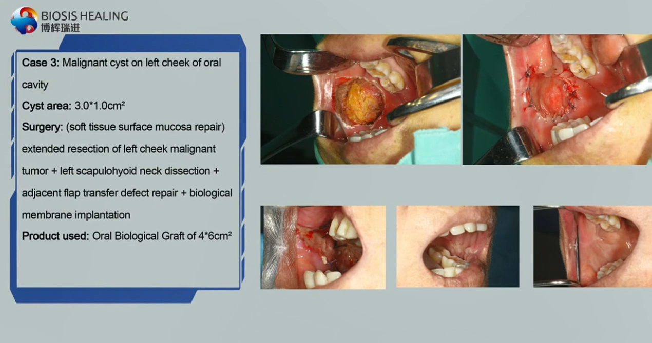 Clincal Fälle von zahnmedizin ischen biologischen Membranen, neue Dental Biological Graft