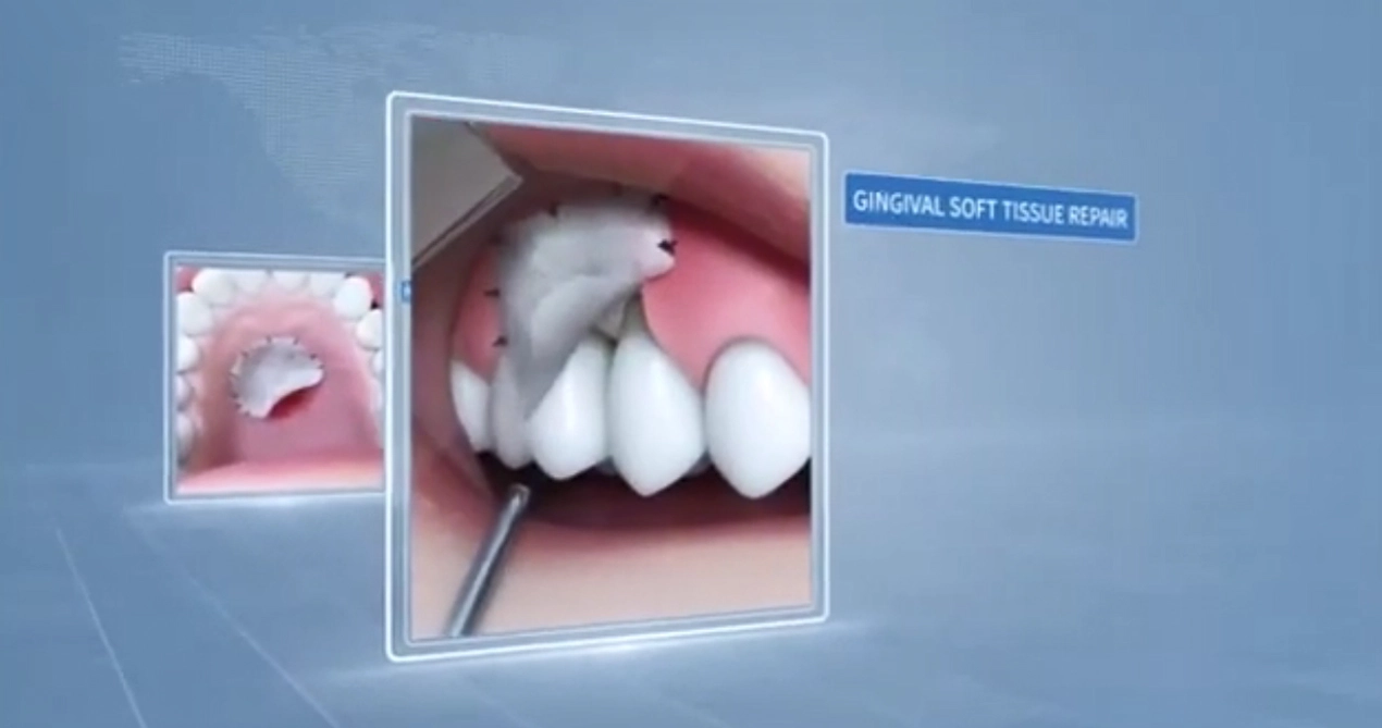 Neue SIS Dental Biological Graft (Zahn membran)
