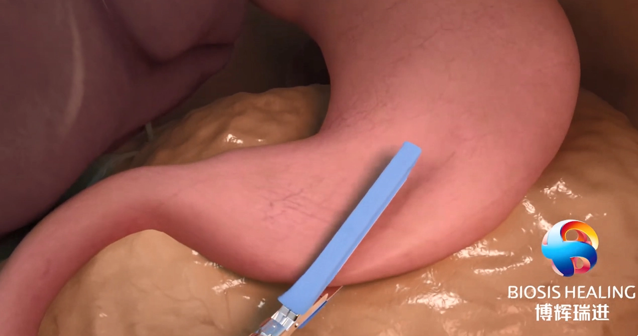 Staple Line Bewehrung (SLR) zur Reduzierung von Lecks