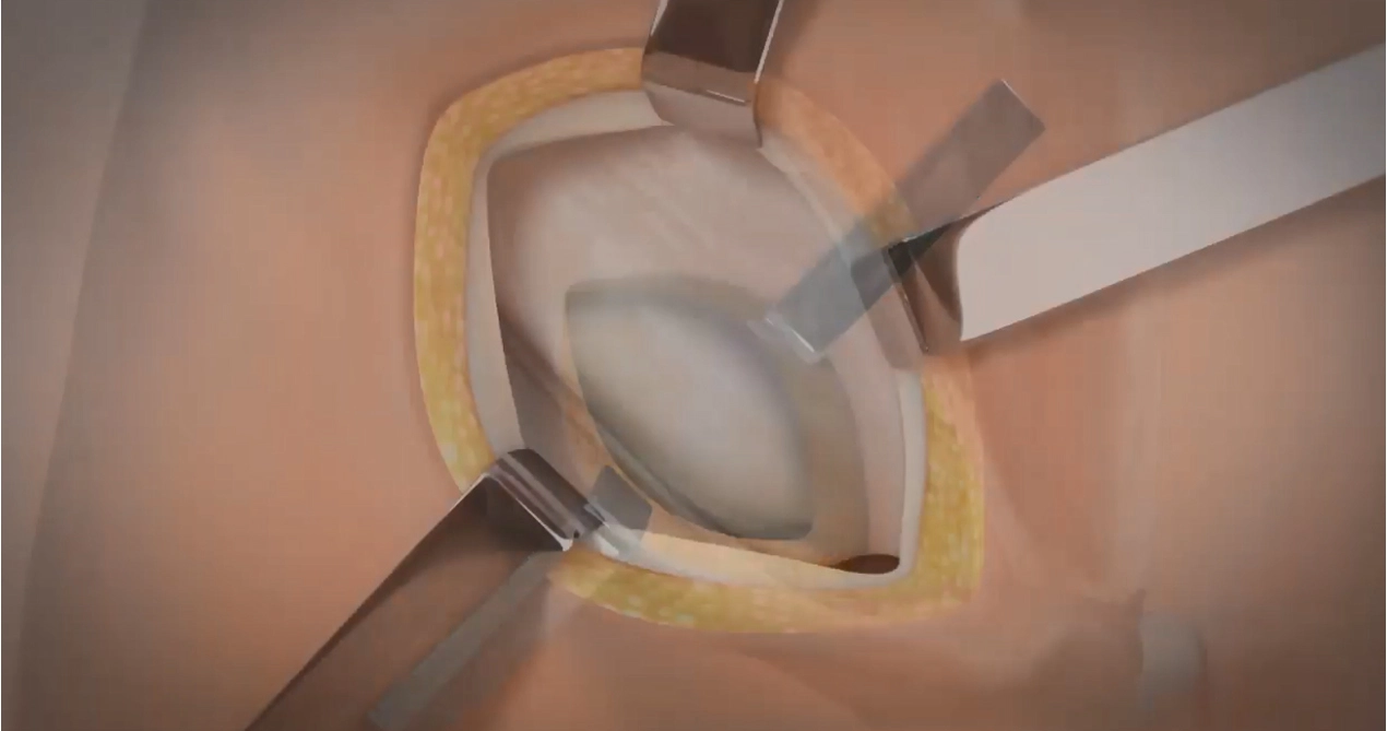 Lichtenstein Hernien reparatur mit SIS-resorbierbarem Netz