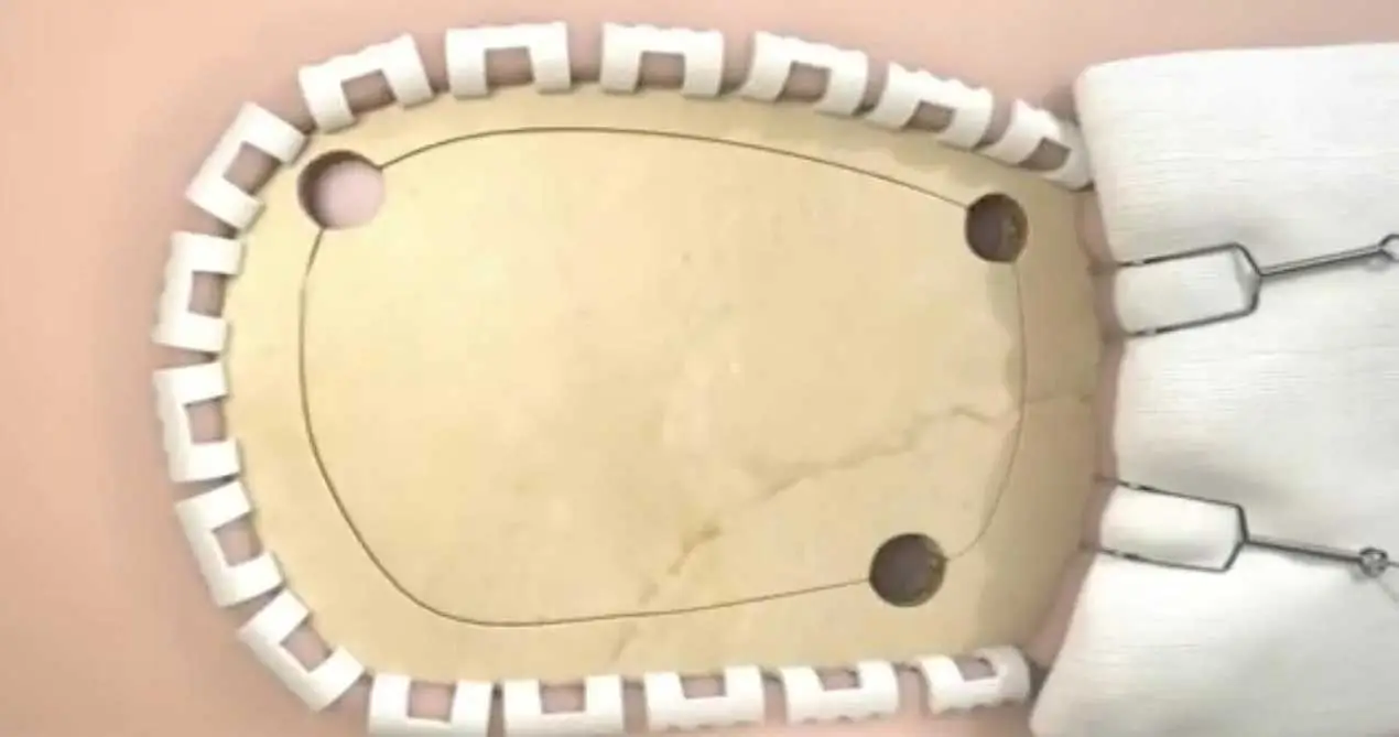 Dural-Reparatur-Patch