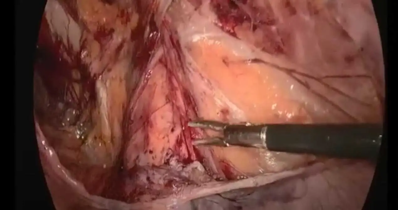 SIS Biologisches Netz 13x15cm TAPP-Chirurgie für Hernien reparatur