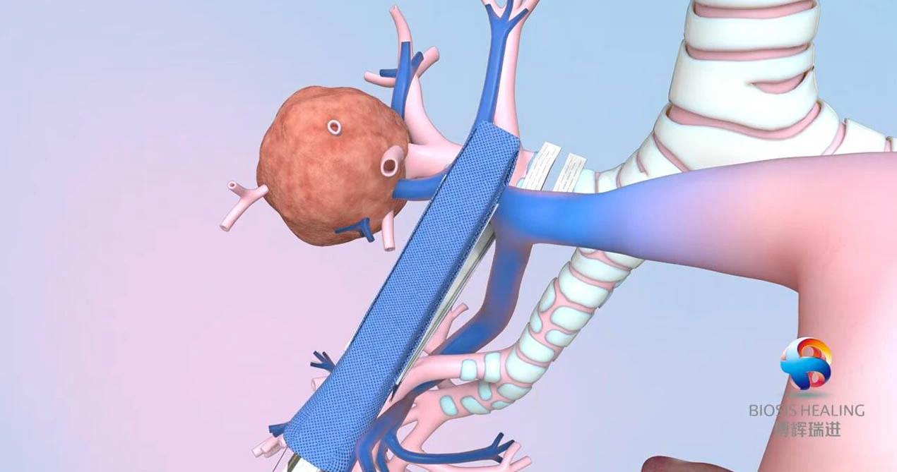 Heft linie Verstärkung für Lobektomie