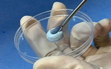 Knochen transplantation material